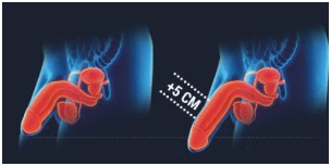 泰坦凝胶是如何增加阴茎尺寸的？